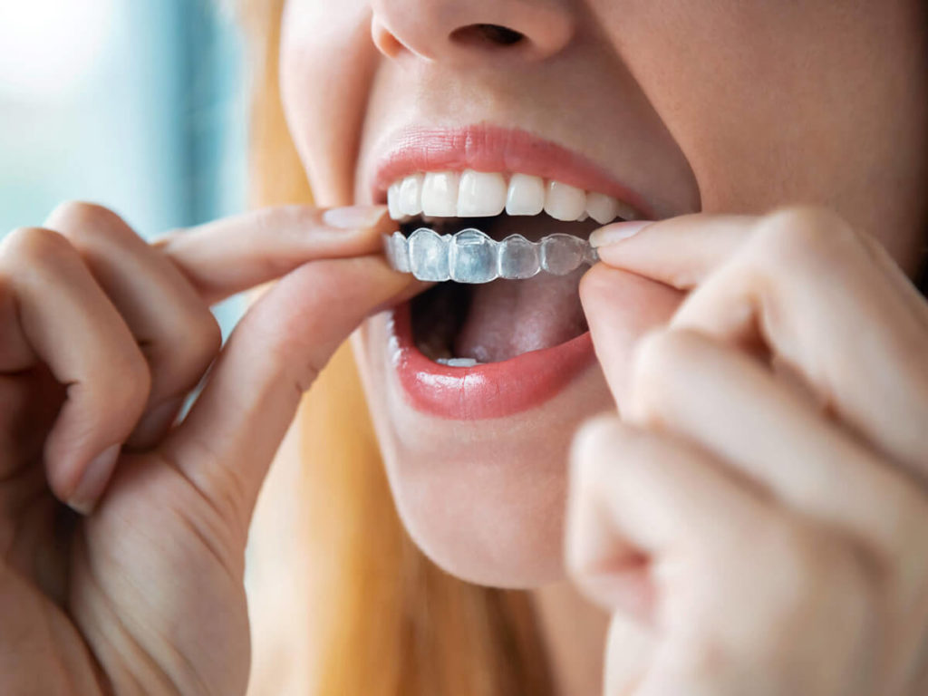 woman inserting Invisalign clear aligners to the top row of her mouth