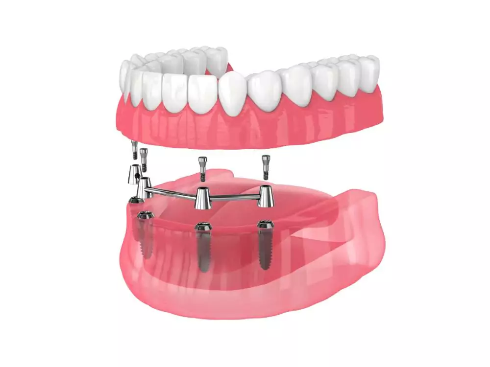 illustration of an entire row of implants being applied to the bottom row
