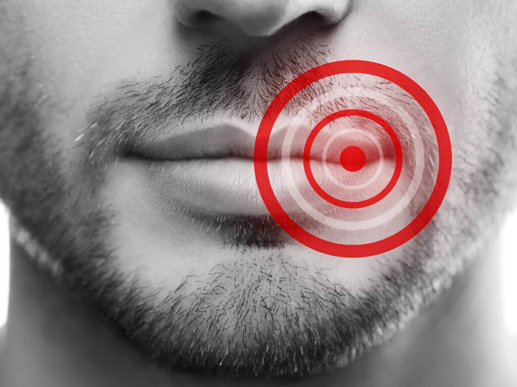 a close up of a man's lower face showing a red dot representing a cold sore