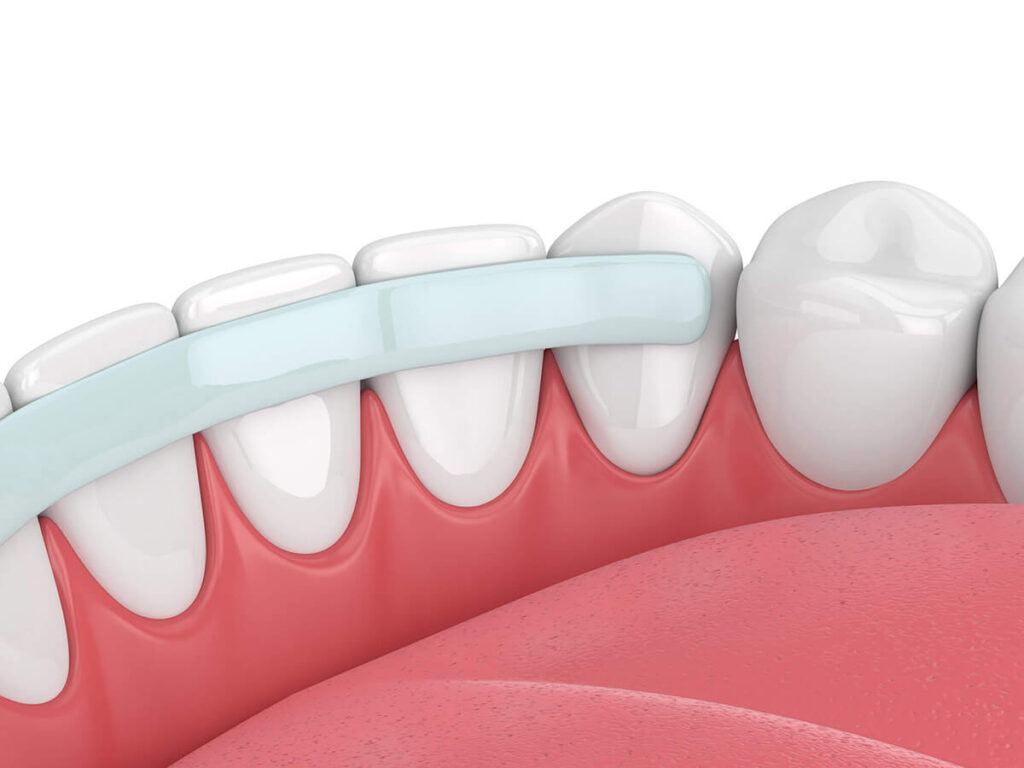 visual of a bottom row of teeth receiving dental bonding