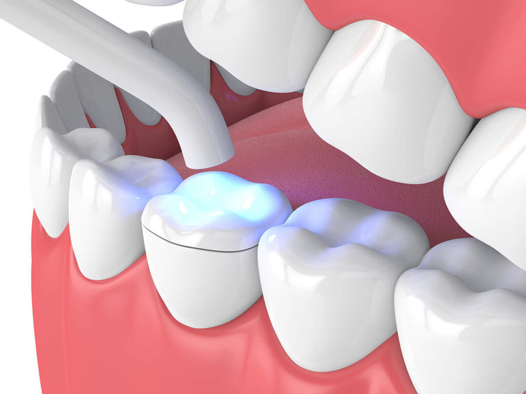 digital visual of a bottom row tooth receiving a dental inlay