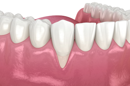 a digital depiction of a bottom row tooth needing gum grafting