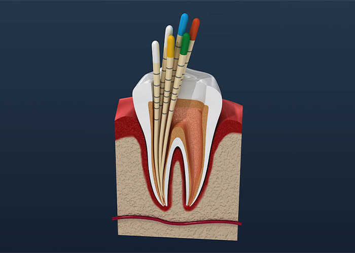 illustration of a tooth getting a root canal