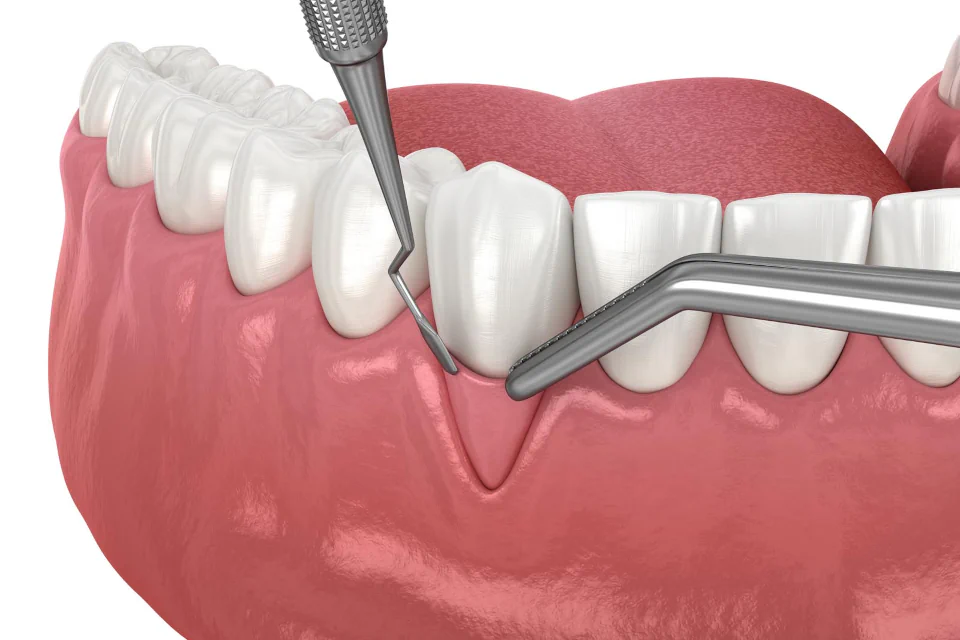 Gum grafting services available at Habersham Dental in Savannah, GA