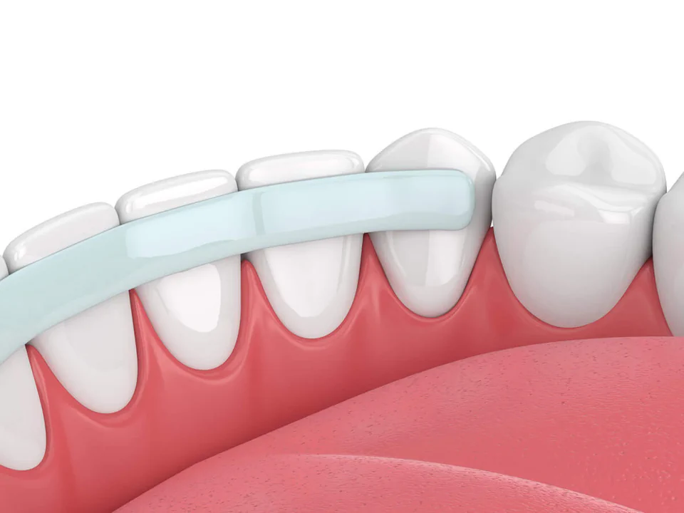Dental bonding services available at Habersham Dental in Savannah, GA