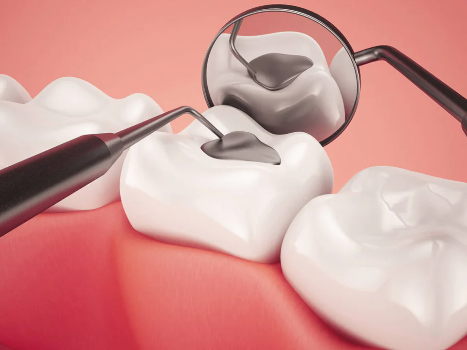 Dental fillings and dental sealants available at Habersham Dental in Savannah, GA