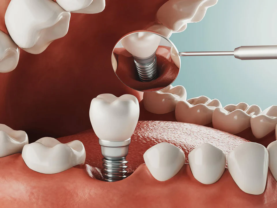 Dental implants and implant services available at Habersham Dental in Savannah, GA