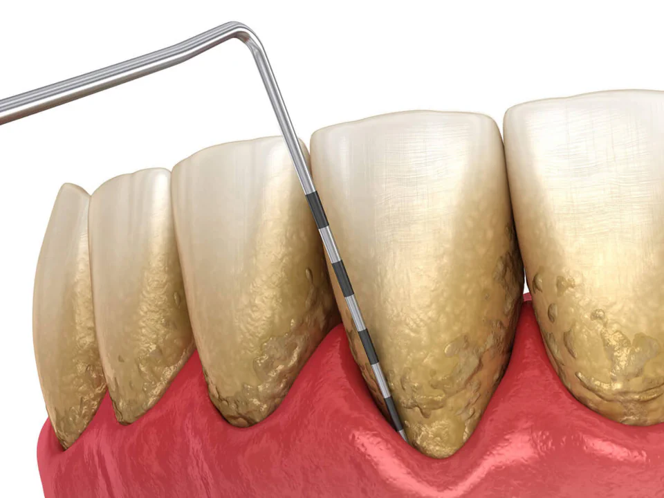 Gum disease treatment and periodontal treatment at Habersham Dental in Savannah, GA