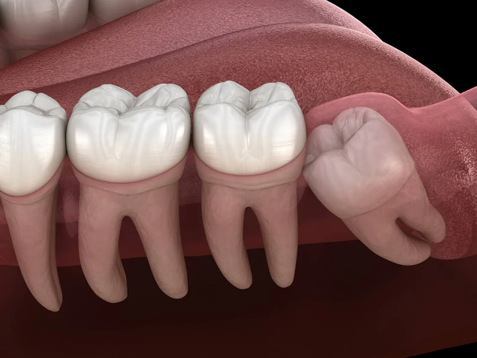 Wisdom teeth removal available at Habersham Dental in Savannah, GA