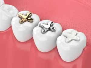 Mercury-free fillings available at Habersham Dental in Savannah, GA