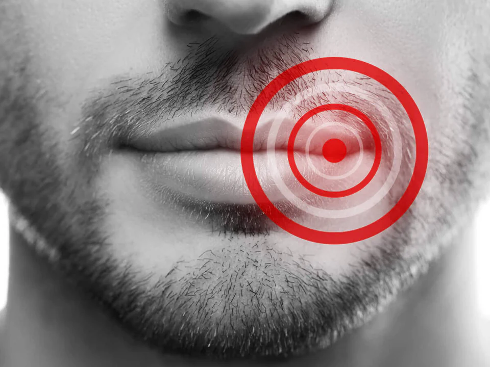 Cold Sore Treatment