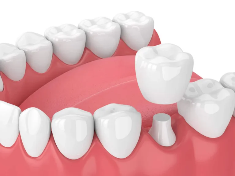 Dental crowns and dental bridges available at Habersham Dental in Savannah, GA